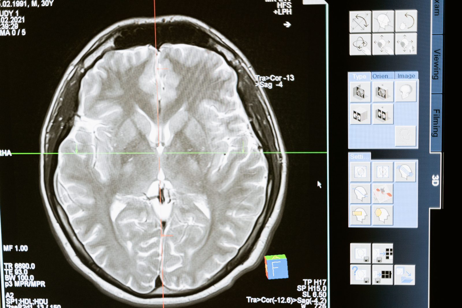 A new brain stimulation therapy matched ECT for severe depression with less memory loss